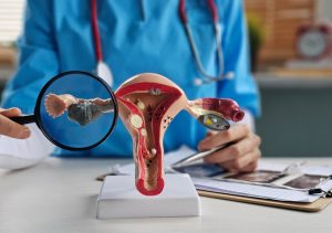 Früherkennung von Endometriose: Erforschung neuer Diagnosemethoden 1